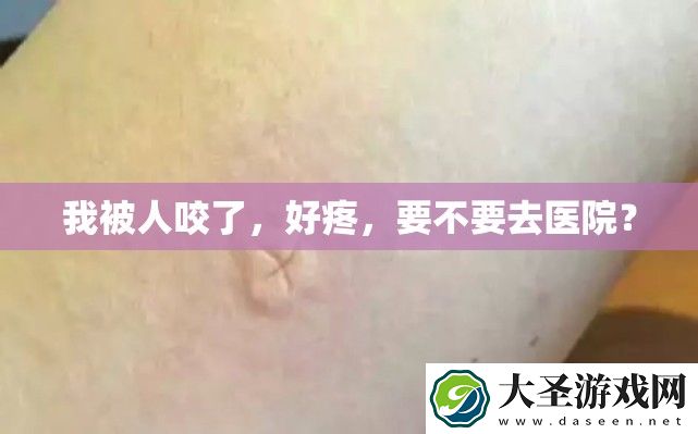我被人咬了